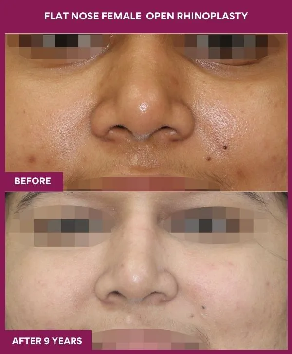 flat-nose-rhinoplasty-before-after-results-mumbai-india-patient03-front