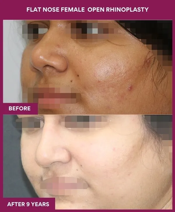 flat-nose-rhinoplasty-before-after-results-mumbai-india-patient03-side-left