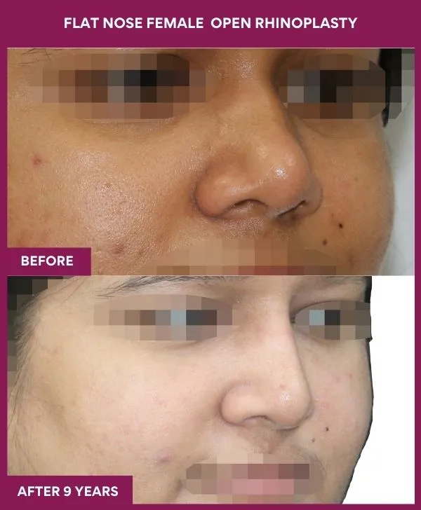 flat-nose-rhinoplasty-before-after-results-mumbai-india-patient03-side-right