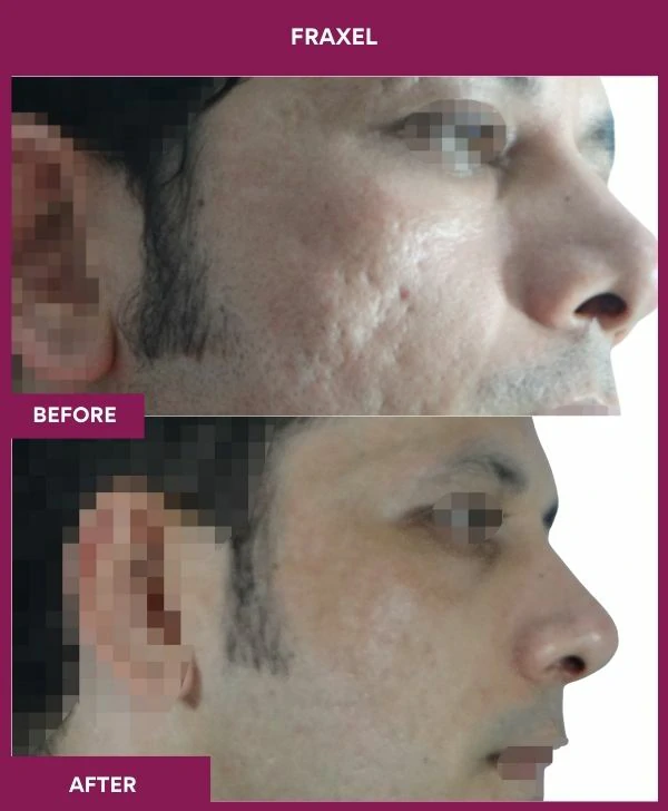 fraxel-laser-treatment-before-after-results-mumbai-india-patient01-side-right