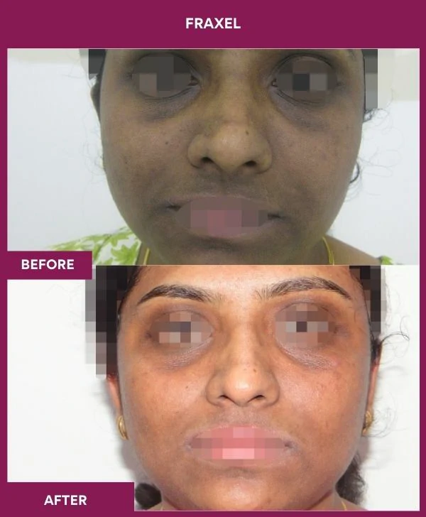 fraxel-laser-treatment-before-after-results-mumbai-india-patient13-front