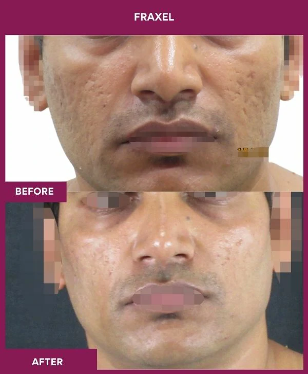 fraxel-laser-treatment-before-after-results-mumbai-indiapatient14-front