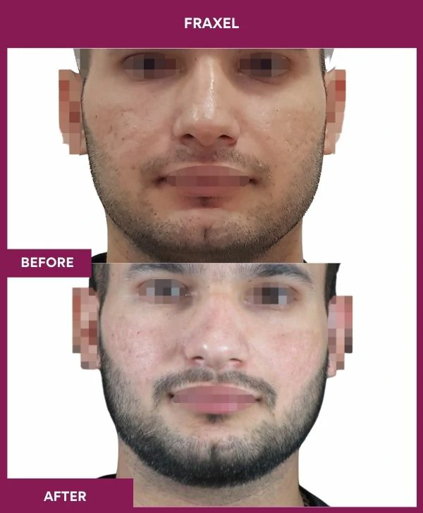 fraxel-laser-treatment-before-after-results-mumbai-india-patient16-front