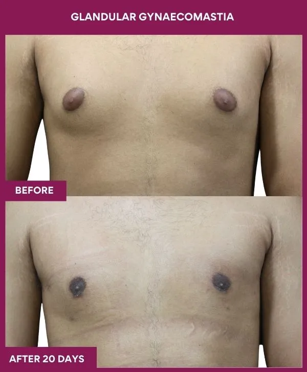 glandular-gynecomastia-surgery-before-after-results-mumbai-india-patient01-front