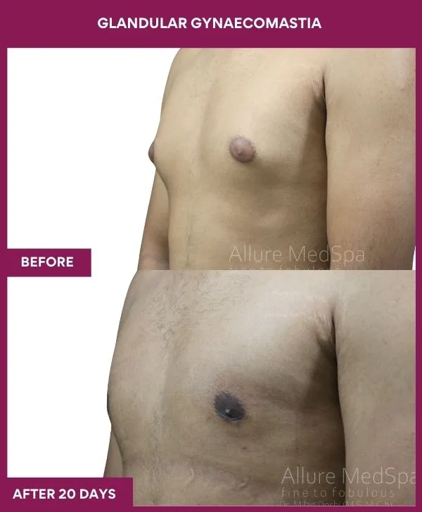 glandular-gynecomastia-surgery-before-after-results-mumbai-india-patient01-side-left