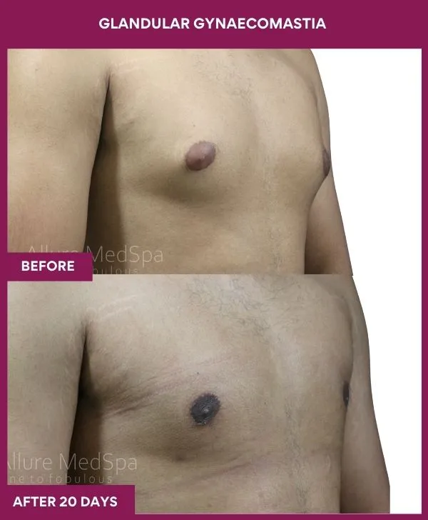 glandular-gynecomastia-surgery-before-after-results-mumbai-india-patient01-side-right