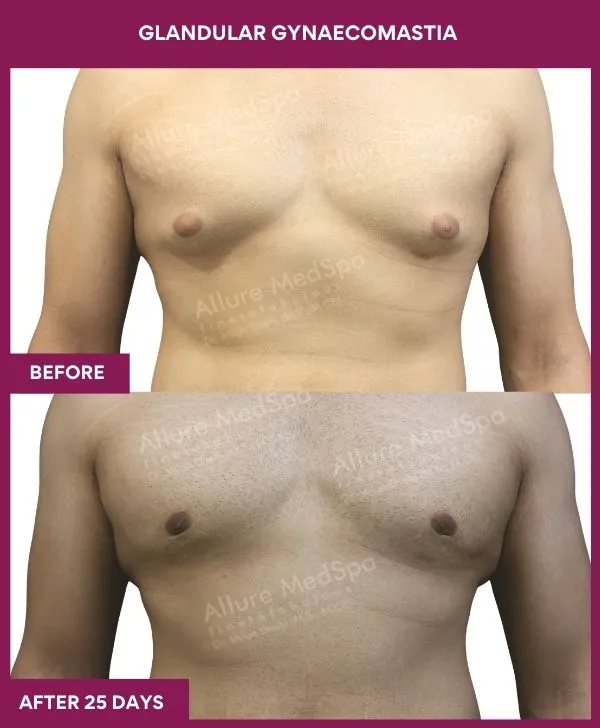 glandular-gynecomastia-surgery-before-after-results-mumbai-india-patient02-front