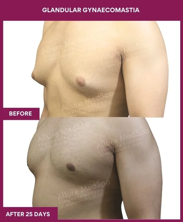 glandular-gynecomastia-surgery-before-after-results-mumbai-india-patient02-side-left