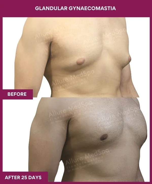 glandular-gynecomastia-surgery-before-after-results-mumbai-india-patient02-side-right