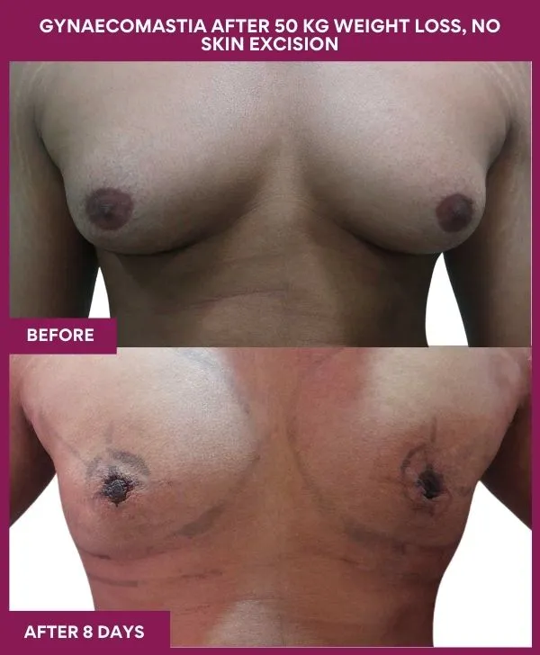 gynecomastia-surgery-after-weightloss-mumbai-patient01-front