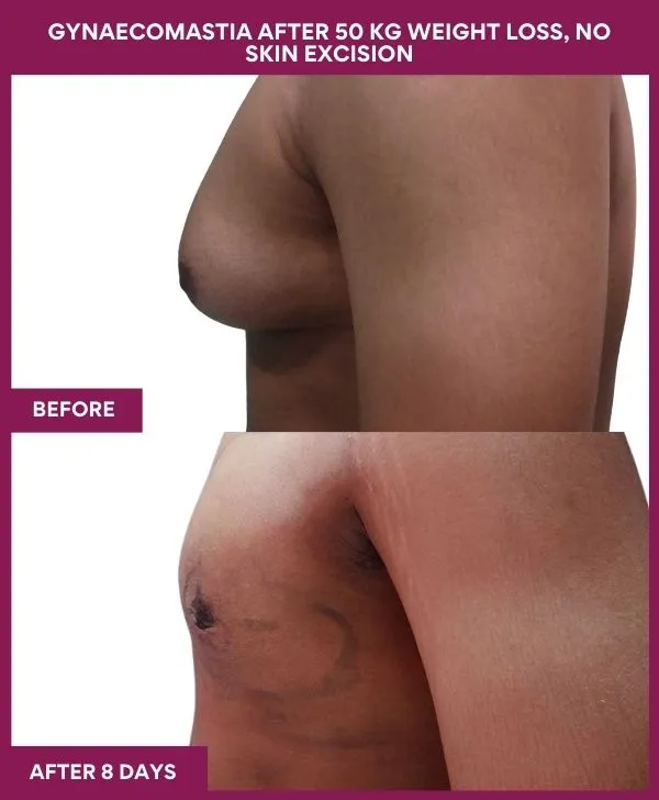 gynecomastia-surgery-after-weightloss-mumbai-patient01-side-left