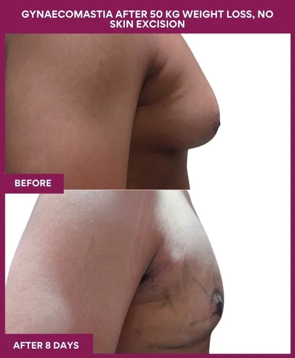 gynecomastia-surgery-after-weightloss-mumbai-patient01-side-right