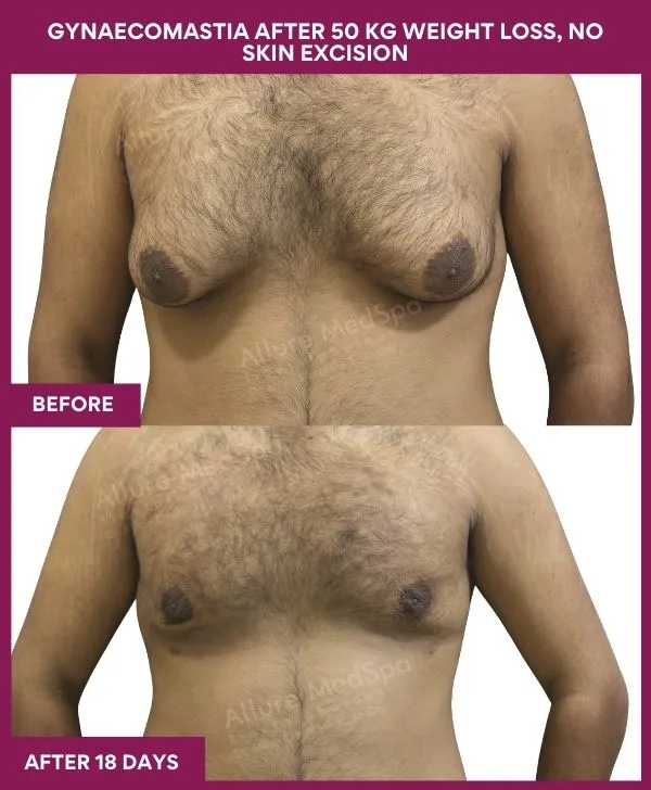 gynecomastia-surgery-after-weightloss-mumbai-patient02-front