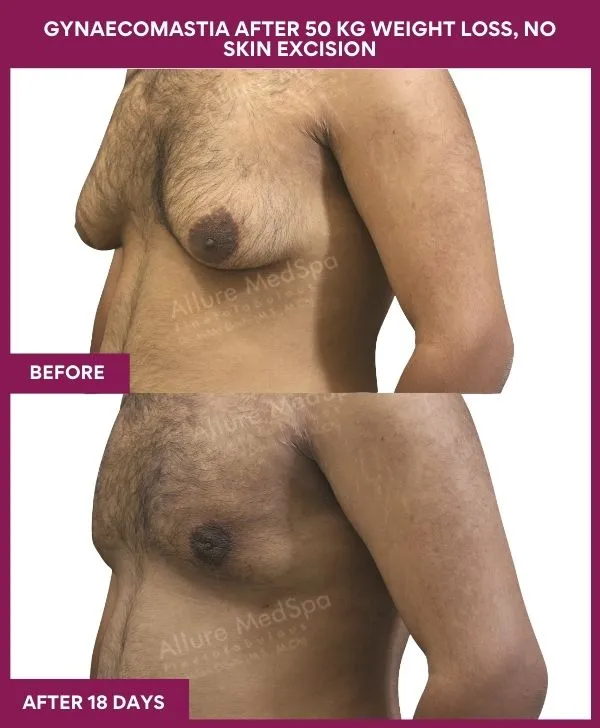 gynecomastia-surgery-after-weightloss-mumbai-patient02-side-left