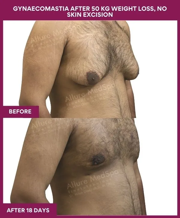 gynecomastia-surgery-after-weightloss-mumbai-patient02-side-right