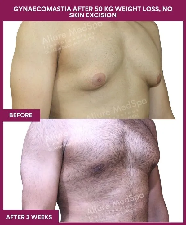 gynecomastia-surgery-after-weightloss-mumbai-patient03-front-right