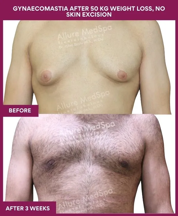 gynecomastia-surgery-after-weightloss-mumbai-patient03-front