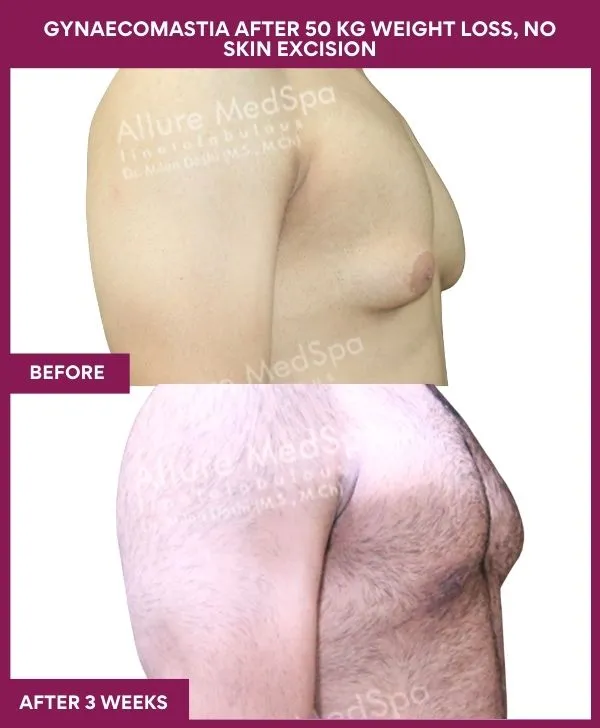 gynecomastia-surgery-after-weightloss-mumbai-patient03-side-right
