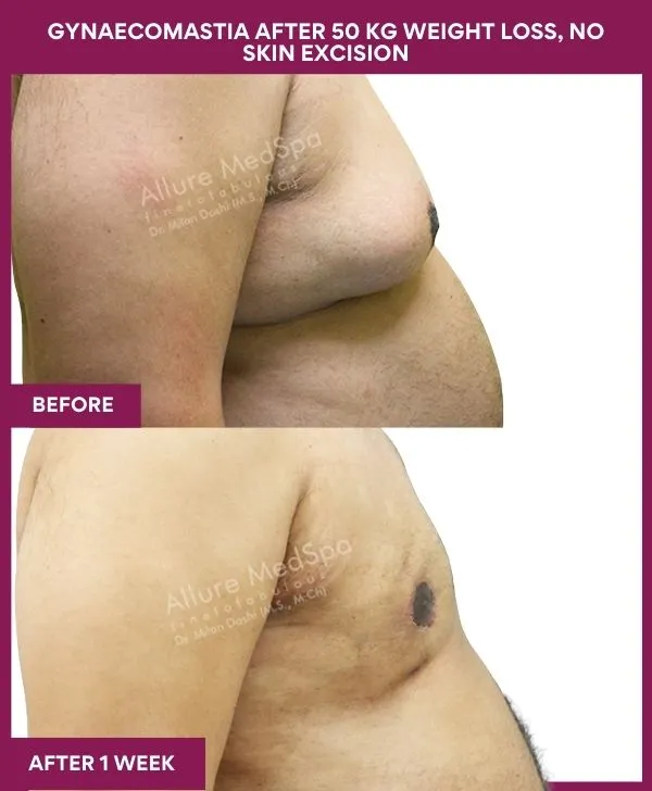 gynecomastia-surgery-after-weightloss-mumbai-patient04-side-right