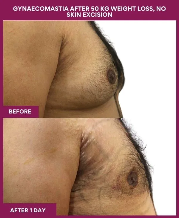 gynecomastia-surgery-after-weightloss-mumbai-patient05-side-right