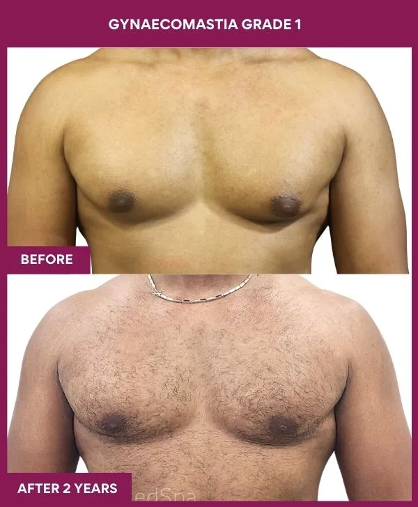 gynecomastia-surgery-grade-1-before-after-results-mumbai-india-patient01-front