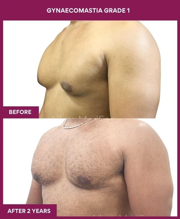 gynecomastia-surgery-grade-1-before-after-results-mumbai-india-patient01-side-left