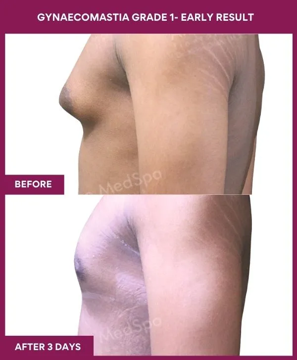 gynecomastia-surgery-grade-1-before-after-results-mumbai-india-patient01-side-left