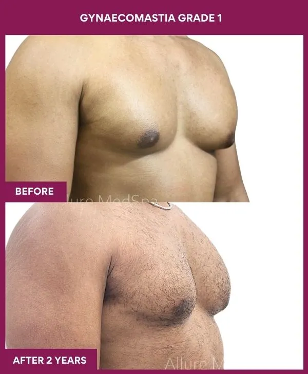 gynecomastia-surgery-grade-1-before-after-results-mumbai-india-patient01-side-right