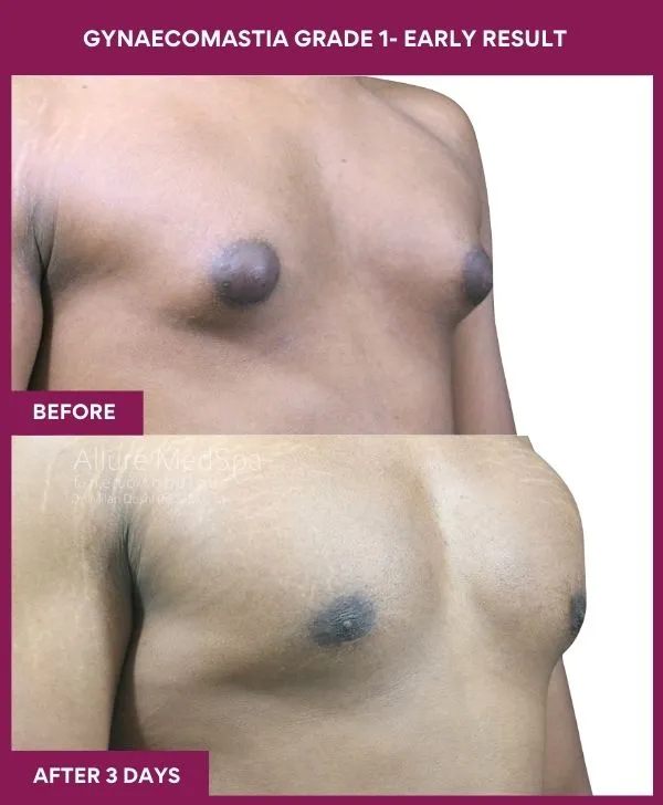 gynecomastia-surgery-grade-1-before-after-results-mumbai-india-patient01-side-right