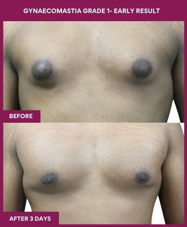 gynecomastia-surgery-grade-1-before-after-results-mumbai-india-patient02-front