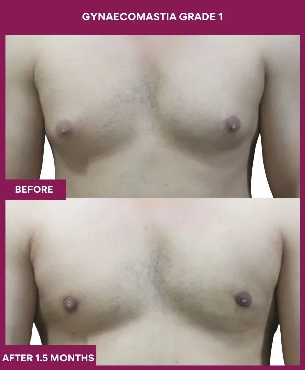 gynecomastia-surgery-grade-1-before-after-results-mumbai-india-patient03-front