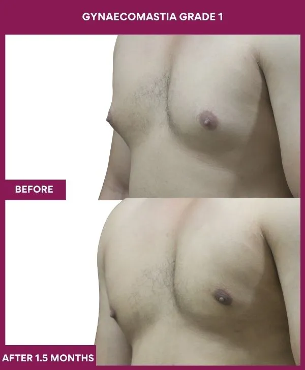 gynecomastia-surgery-grade-1-before-after-results-mumbai-india-patient03-side-left
