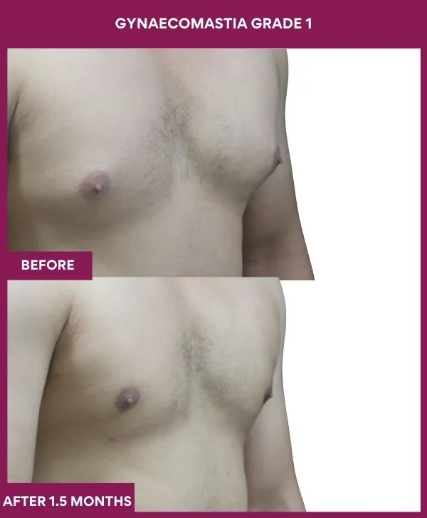 gynecomastia-surgery-grade-1-before-after-results-mumbai-india-patient03-side-right