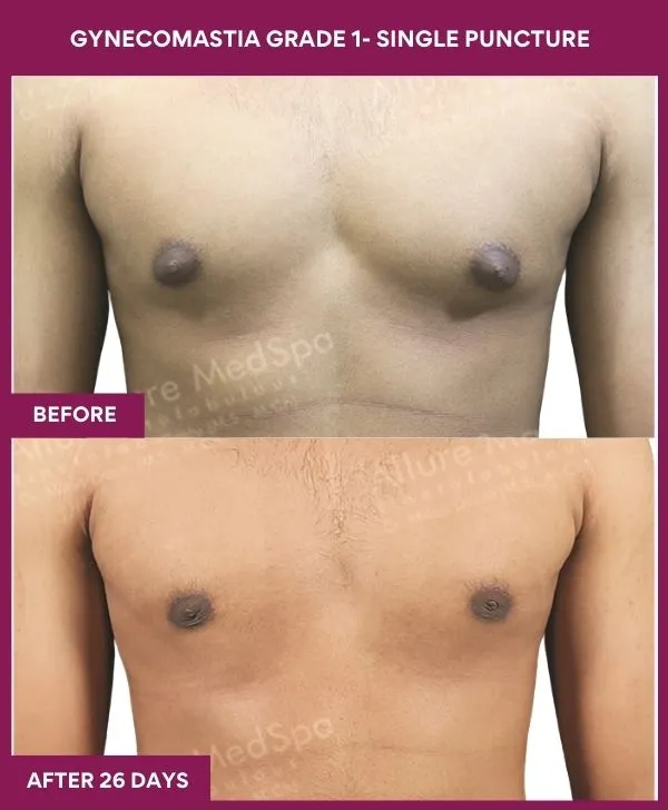 gynecomastia-surgery-grade-1-before-after-results-mumbai-india-patient04-front
