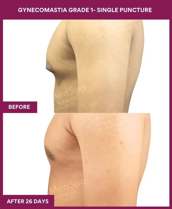 gynecomastia-surgery-grade-1-before-after-results-mumbai-india-patient04-side-left