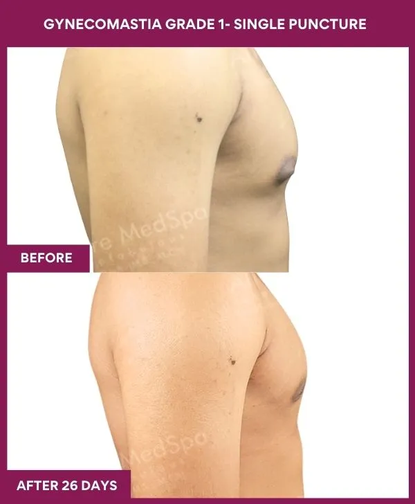 gynecomastia-surgery-grade-1-before-after-results-mumbai-india-patient04-side-right