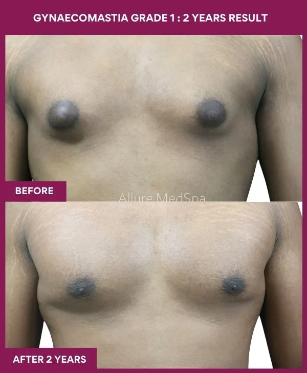 gynecomastia-surgery-grade-1-before-after-results-mumbai-india-patient05-front