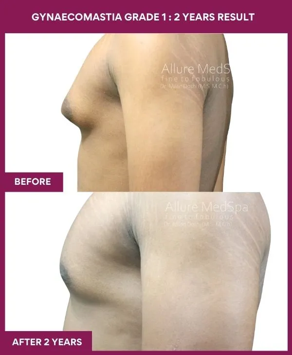 gynecomastia-surgery-grade-1-before-after-results-mumbai-india-patient05-side-left