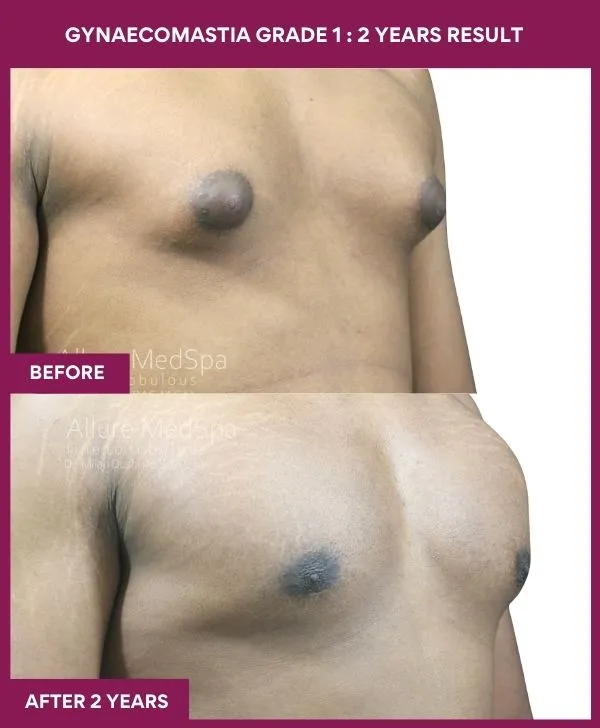 gynecomastia-surgery-grade-1-before-after-results-mumbai-india-patient05-side-right