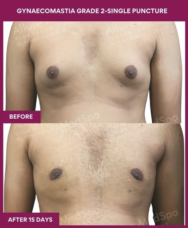 gynecomastia-surgery-grade-2-before-after-results-mumbai-india-patient01-front