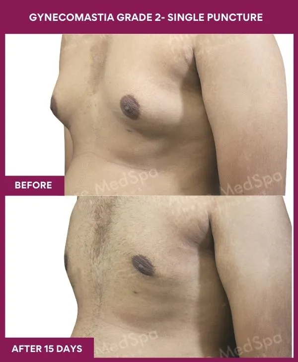 gynecomastia-surgery-grade-2-before-after-results-mumbai-india-patient01-side-left