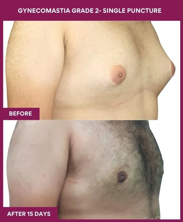 gynecomastia-surgery-grade-2-before-after-results-mumbai-india-patient01-side-right