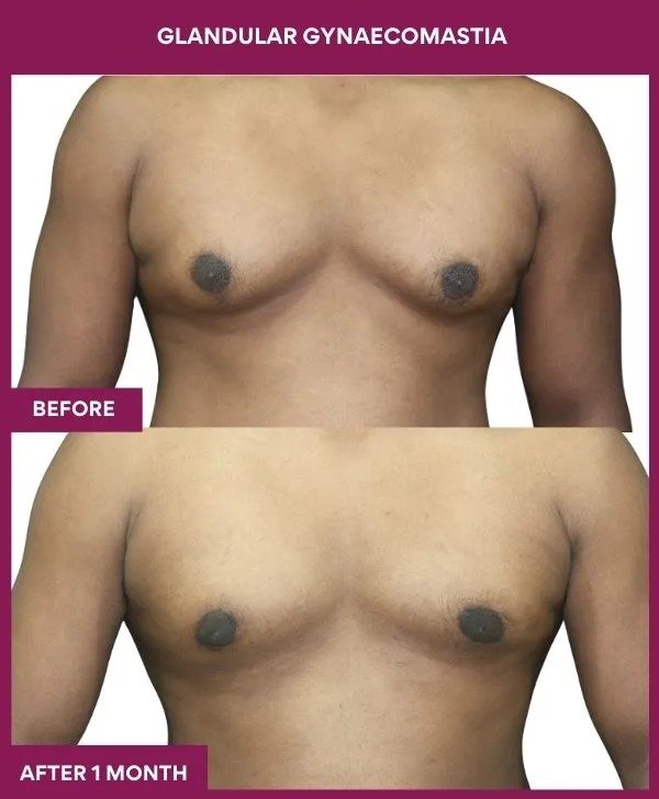 gynecomastia-surgery-grade-2-before-after-results-mumbai-india-patient03-front