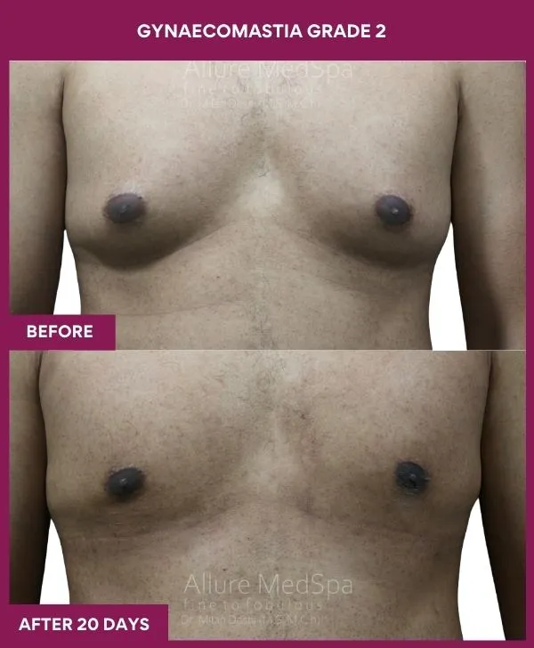 gynecomastia-surgery-grade-2-before-after-results-mumbai-india-patient03-front