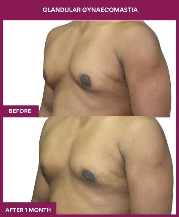 gynecomastia-surgery-grade-2-before-after-results-mumbai-india-patient03-side-left