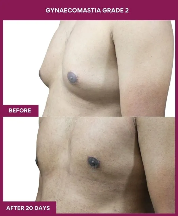 gynecomastia-surgery-grade-2-before-after-results-mumbai-india-patient03-side-left