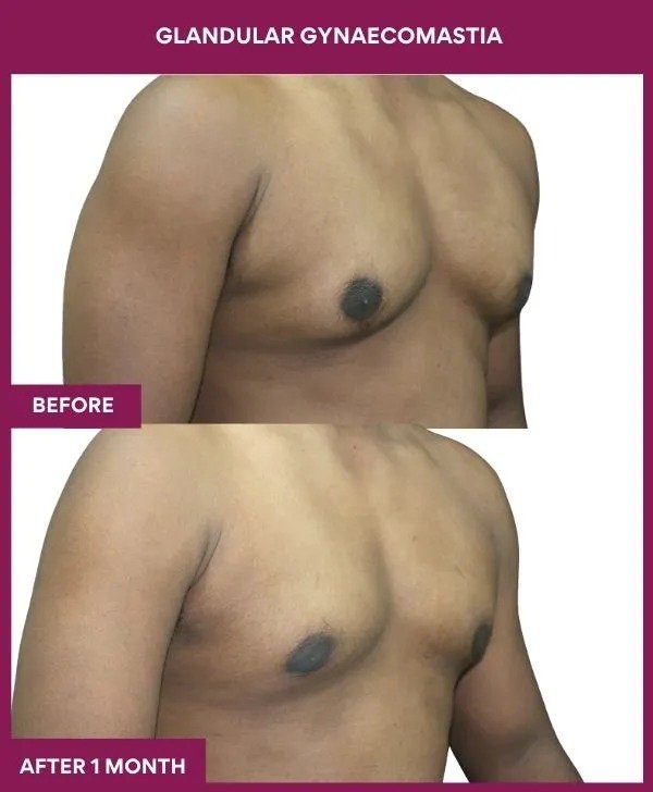 gynecomastia-surgery-grade-2-before-after-results-mumbai-india-patient03-side-right