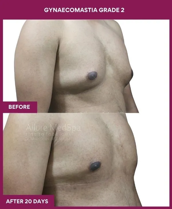 gynecomastia-surgery-grade-2-before-after-results-mumbai-india-patient03-side-right