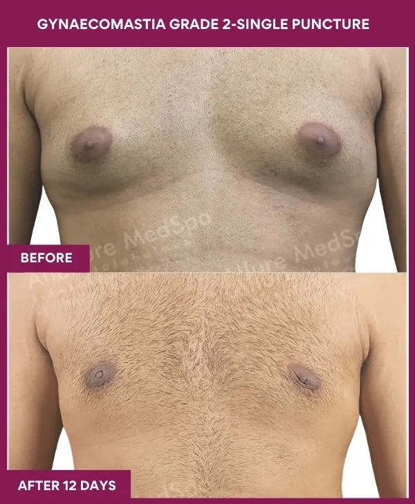 gynecomastia-surgery-grade-2-before-after-results-mumbai-india-patient04-front