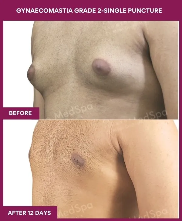 gynecomastia-surgery-grade-2-before-after-results-mumbai-india-patient04-side-left